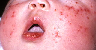 カポジ 水痘 様 発疹 症