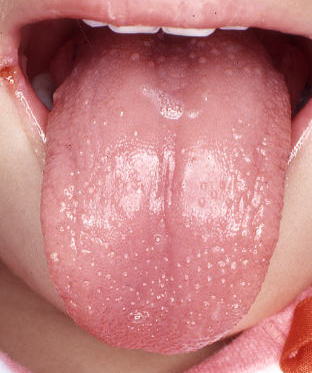 溶連菌以外 いちご舌