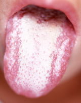 溶連菌以外 いちご舌 大人の溶連菌感染症の3大症状は？仕事の復帰時期、治療法を解説！