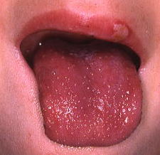 溶連菌以外 いちご舌 いちご舌 溶連菌以外